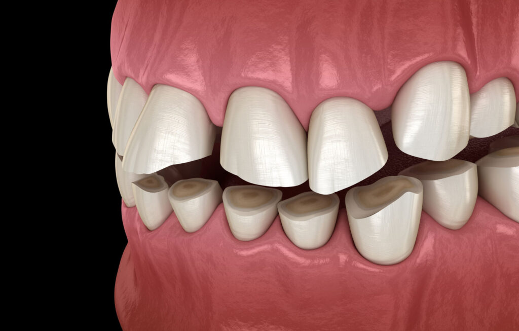 3D model of teeth of someone who can suffer from teeth grinding and parasites